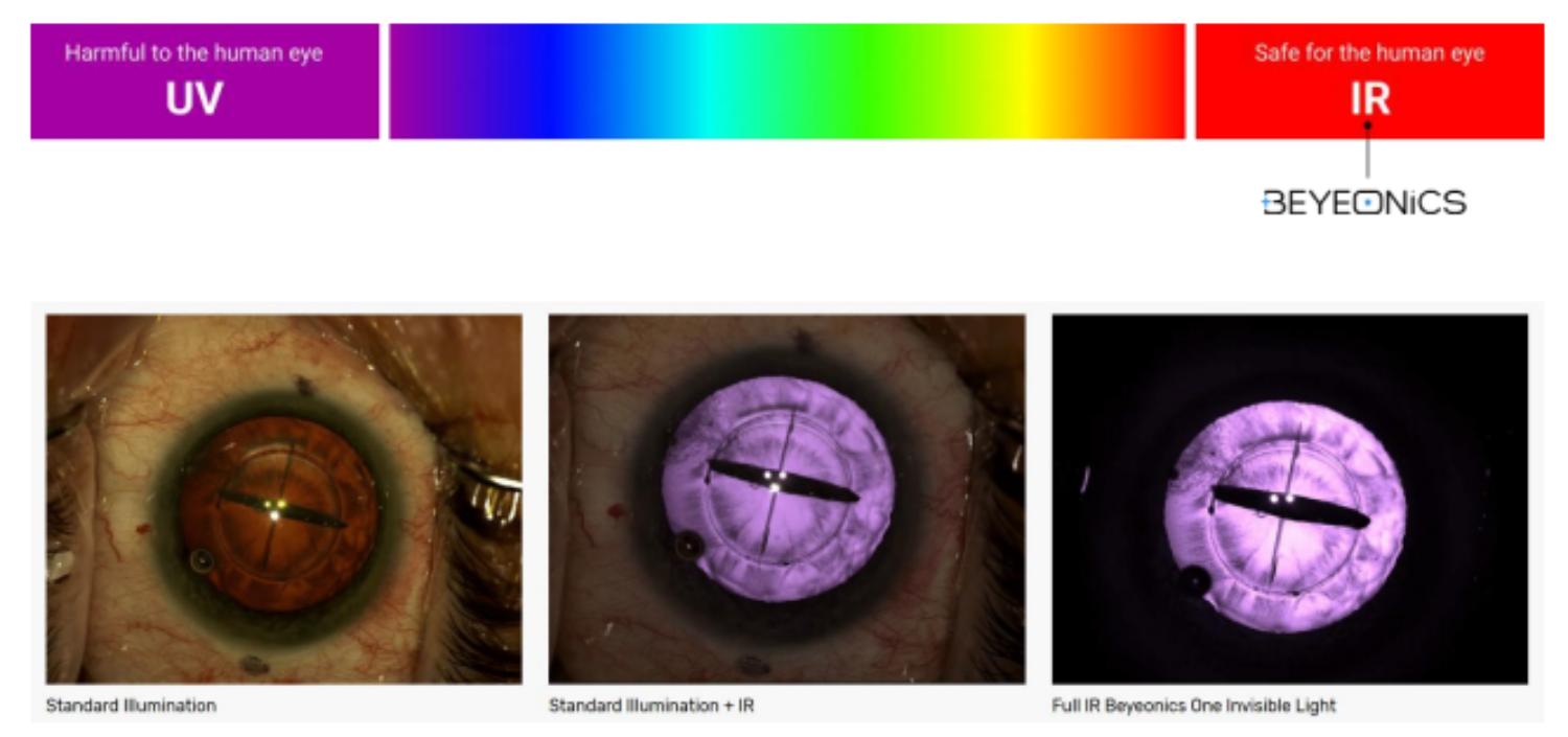 L’Ospedale Koelliker testa la tecnologia Beyeonics Vision: una nuova era per la chirurgia oftalmica